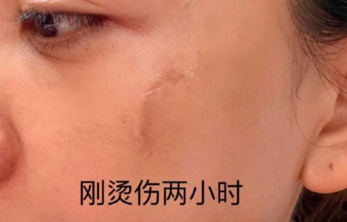 烫伤9天后疤痕基本消退!杨蓉晒带疤的脸直言很酷